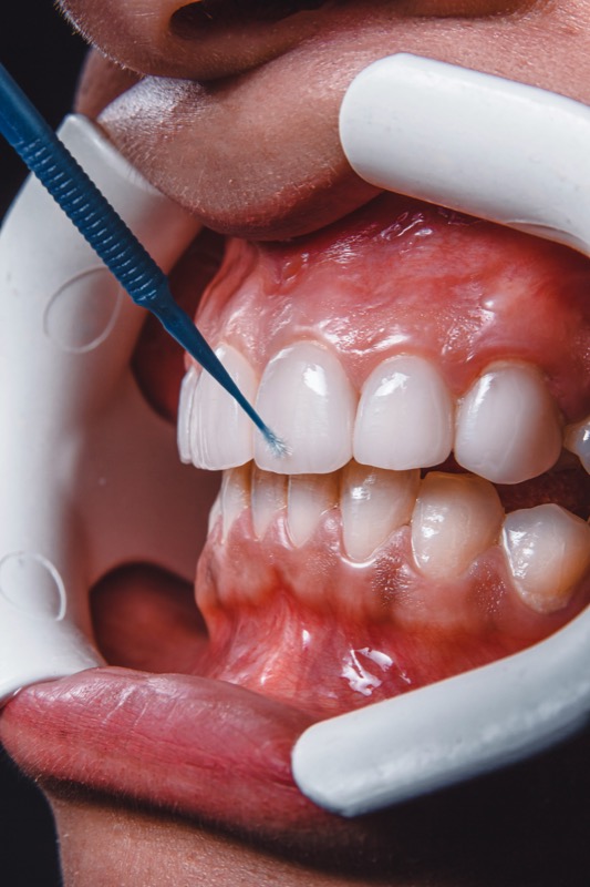 Healthy smile care at Glaze Dental