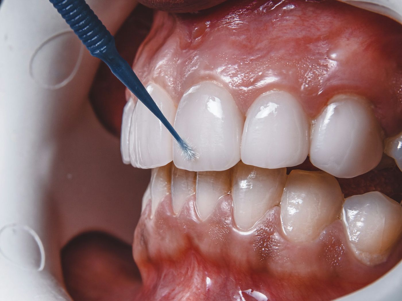 A close view of healthy gums being checked with a periodontal probe
