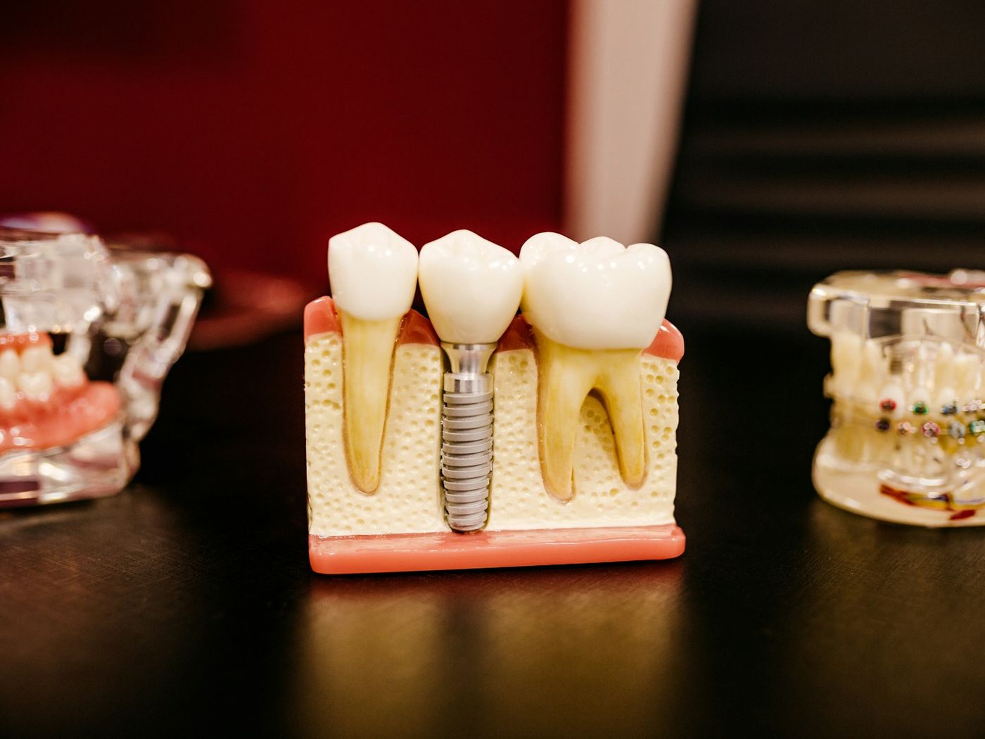 A dental implant model showing the titanium post anchored in the jaw beneath a crown